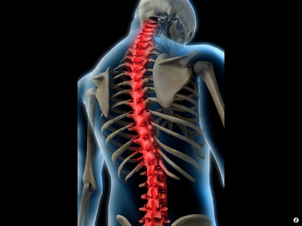 Como são feitos o tratamento, diagnóstico e cirurgia da escoliose